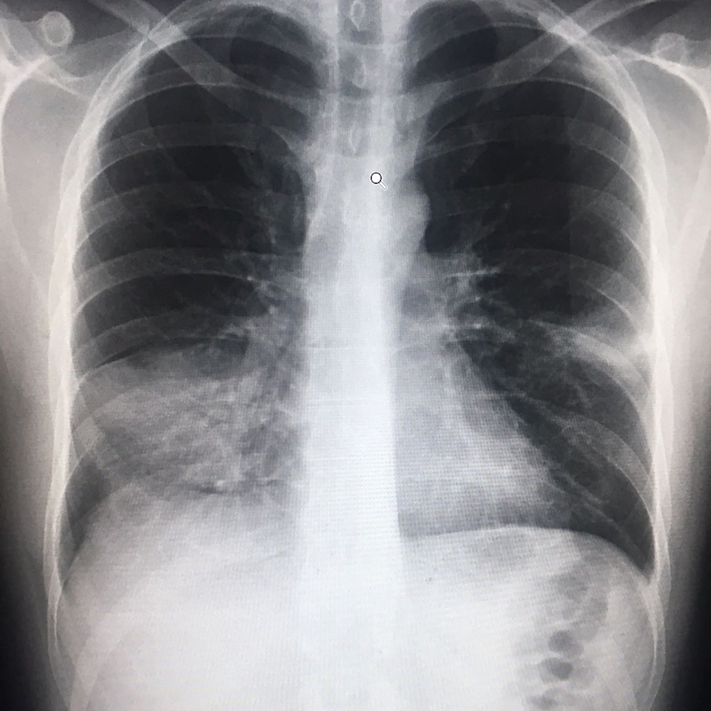 Garry, 35 years old from the UK<br/>The reality of pneumonia can be a very scary and dangerous. Each year, it takes the lives of nearly one million kids. There’s a vaccine to prevent it, but it’s too expensive for many countries to afford. Photographer: MSF