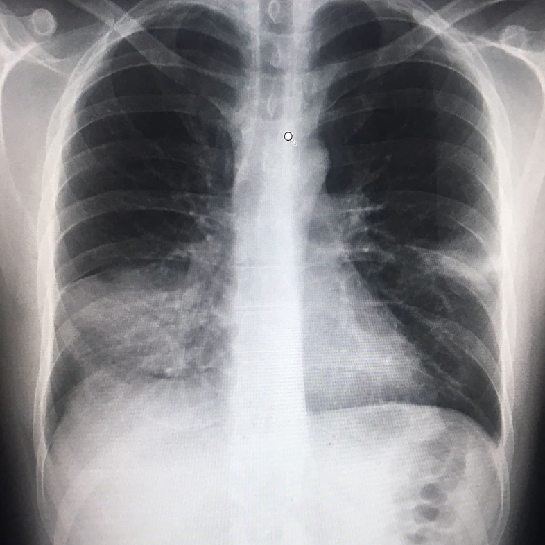 Garry, 35 years old from the UK<br/>The reality of pneumonia can be a very scary and dangerous. Each year, it takes the lives of nearly one million kids. There’s a vaccine to prevent it, but it’s too expensive for many countries to afford. That’s why we need #Pfizer and #GSK to drop the price to $5/child for all developing countries and humanitarian organizations. #AskPharma http://afairshot.org. Photographer: MSF