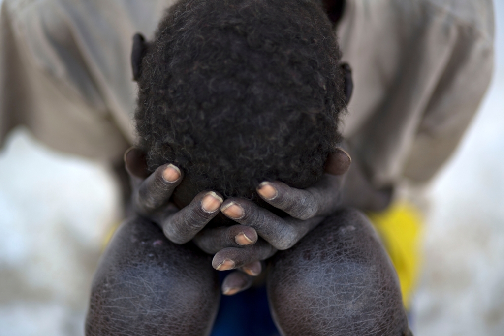 System identifier: MSB17339<br/>Title: SOUTH SUDAN KALA AZAR<br/>Photographer / cameraman: Karel Prinsloo<br/>Countries: South Sudan<br/>Description: A kala azar patient rests at a Médecins Sans Frontières hospital in Lankien, South Sudan, 13 January 2015.
