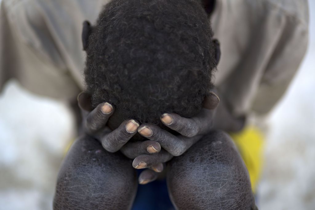 © Karel Prinsloo<br/>Le conflit au Soudan du Sud rend les populations plus vulnérables aux maladies tropicales comme le Kala Azar. Le risque d’infection est plus important pour les personnes déplacées par les combats dans des zones où la maladie est plus présente et la malnutrition diminue leur capacité à lutter contre l’infection. Beaucoup de centres de santé sont fermés et trouver un traitement est de plus en plus difficile.