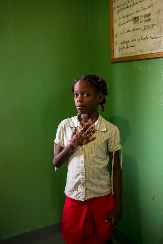 Fedia Fontenel, aged nine, burnt her hand in the kitchen of her home in Mariani. Three times a week she meets with Josue Toussaint, an MSF social worker, for physiotherapy at the burns unit in Drouillard hospital, Port-au-Prince. Photographer: Corentin Fohlen