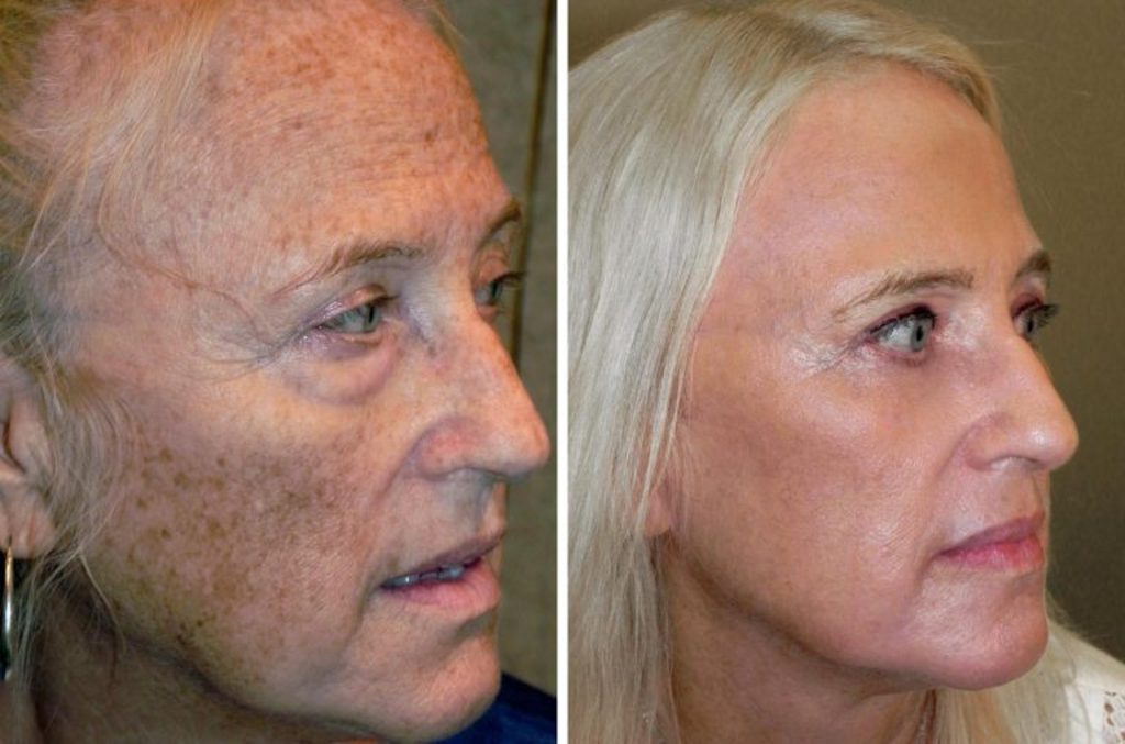 Before and After RESET