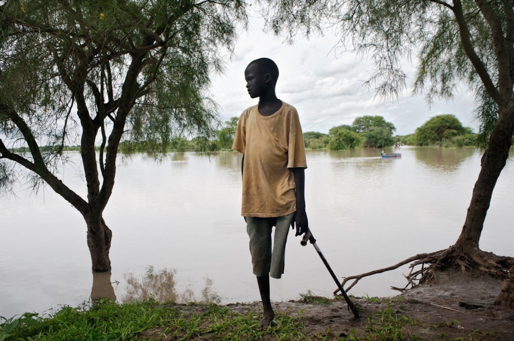 A boy, with an amputated leg due to lack of access to care after being bitten by a snake, on the banks of the Pibor River in Jonglei State. Up to 75 per cent of people cannot access even the most basic healthcare in South Sudan. Apart from a small Ministry of Health facility in Pibor town, MSF is the only primary healthcare provider for over 160,000 people in this part of Jonglei State. Photographer: Cédric Gerbehaye