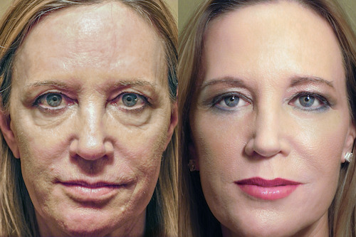 RESET patient before and after surgery with make-up.