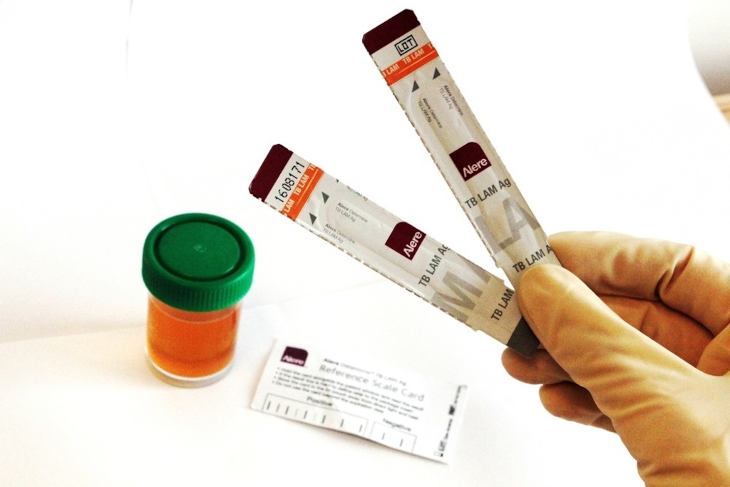 TB LAM test. Photographer: MSF