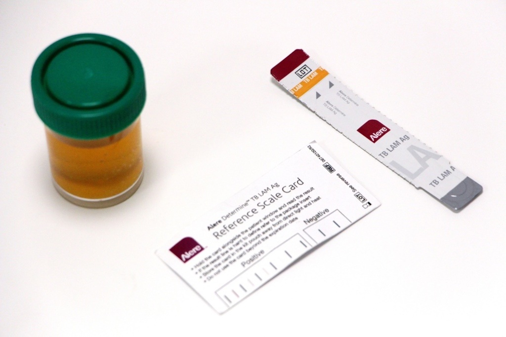 TB LAM test. Photographer: MSF