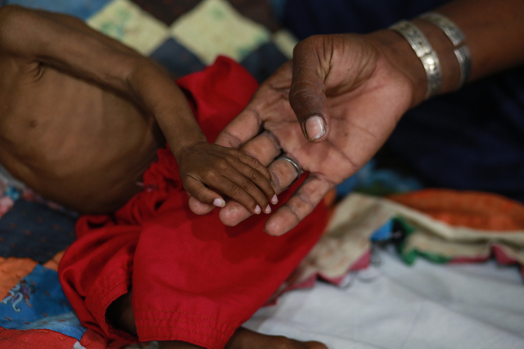 A mother holds her severely malnourished daughter's hand as she cries in pain at the children's ward managed by the MSF team at the DHQ hospital in Dera Murad Jamali in Balochistan, Pakistan. Photographer: Sara Farid