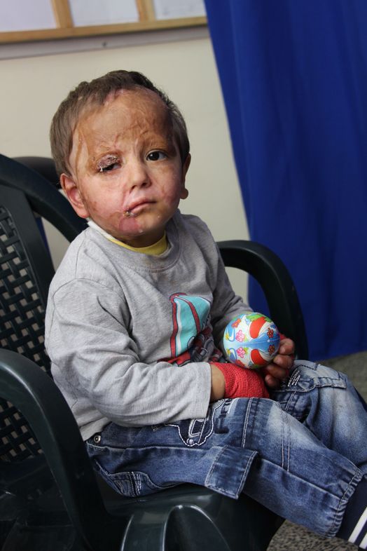 Mohammad 3 years old and his grandmother at Khan Younis clinic for dressing care and physio, follow up on severe burns injuries, domestic accident, a neighbour threw boiling oil out of the window and the little boy was outside. First at Nasser Hospital where he was immediately transferred to the ICU and then they transferred him to Jerusalem where he got some skin grafts. And after coming back from Israel we came with him to the MSF clinic in Khan Younis, and was taken care of the team. He was also in surgery in the MSF surgical round in April 2015. The MSF surgical team operated on his upper eye lid, his right arm, and for the mouth opening. We are now regularly in the MSF clinic for physiotherapy, dressing care, burn rehabilitation, because he just came out of surgery. © Susanne Doettling/MSF