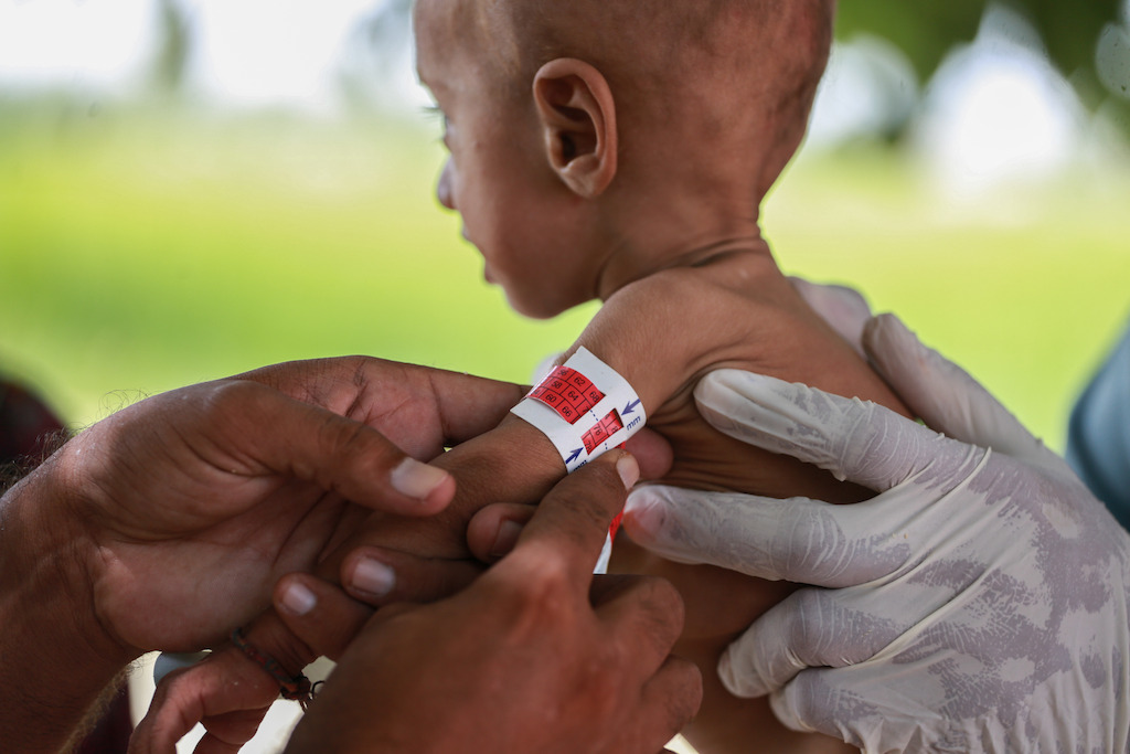 MSF nurse checks the mid-upper arm circumference of young Yasin for indication of malnutrition. Yasin is admitted to the feeding program and is here on a second visit. Photographer: Sara Farid